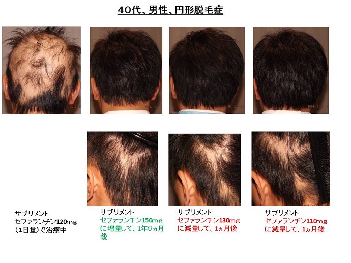 円形脱毛症　病院""